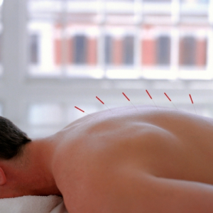 Acupuntura